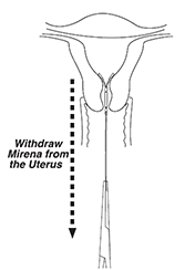 Illustration shows withdrawal of Mirena (levonorgestrel-releasing intrauterine system) 52 mg IUD from the uterus.