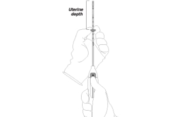 Illustration of Mirena (levonorgestrel-releasing intrauterine system) 52 mg IUD insertion step 3: setting the IUD flange.