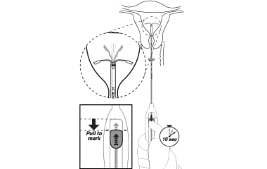 Illustration of Mirena (levonorgestrel-releasing intrauterine system) 52 mg IUD insertion step 5: open the arms.