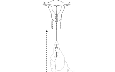 Illustration of Mirena (levonorgestrel-releasing intrauterine system) 52 mg IUD insertion step 6: advance to the fundal position