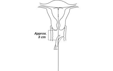 Illustration of Mirena (levonorgestrel-releasing intrauterine system) 52 mg IUD insertion step 8: cut IUD threads.