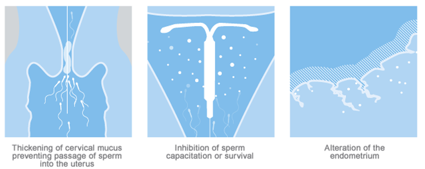 Mirena® (levonorgestrel-releasing intrauterine system) 52 mg IUD mechanism of action